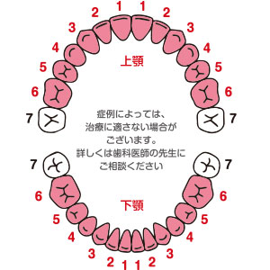 CAD/CAM冠用『アベンシアブロック』適応図