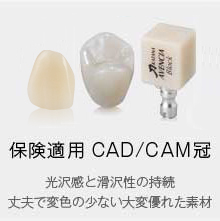 CAD/CAM冠